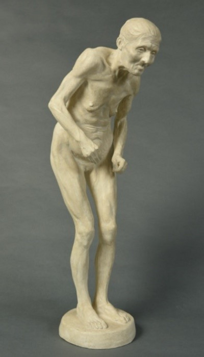 Paul Richer, sculpture « La Parkinsonienne », 1895